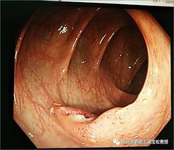 白塞氏病 一种罕见却复杂的免疫系统疾病
