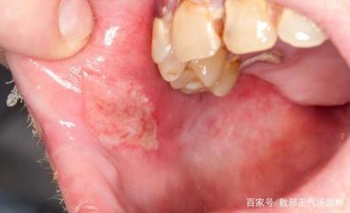 白塞氏病严重并发症 从眼部炎症到血管神经系统损害