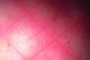 血管炎与白塞病 是同一类疾病吗？