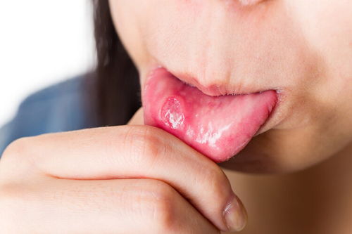 口腔溃疡反复难愈？警惕白塞病在作祟