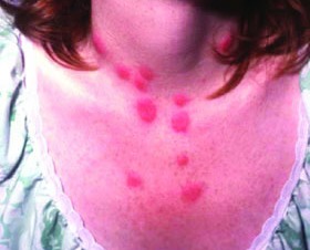 白塞病患者反复发热的常见原因探析