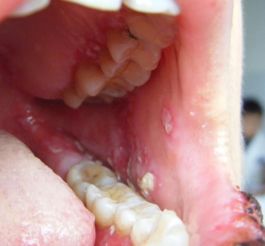 白塞病患者适合食用的水果及饮食建议