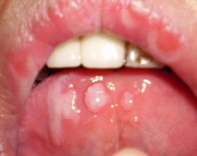 经常烂嘴是白塞病吗？详解白塞氏病的症状与识别