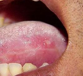 白塞病患者能否吃鸡？全面解析饮食与白塞病的关系